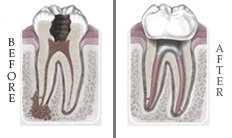 Root canal treatment illustration