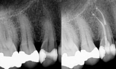 Dental X-ray used in endodontic diagnosis